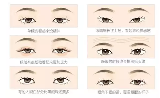 關(guān)于重瞼術(shù)，你要了解的那些事兒
