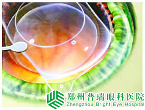青光眼患者該何時做手術