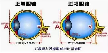 近視眼球突出？！控制近視度數(shù)加深是關(guān)鍵！