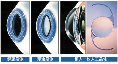 ICL晶體植入術——高度近視優(yōu)選方式