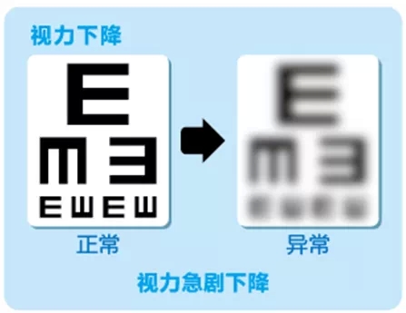 視網(wǎng)膜脫離啥癥狀？這張圖告訴你！
