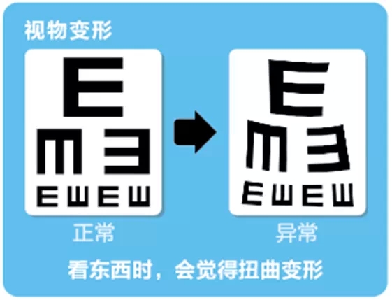 視網(wǎng)膜脫離啥癥狀？這張圖告訴你！