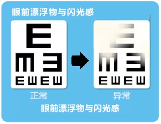 視網(wǎng)膜脫離啥癥狀？這張圖告訴你！