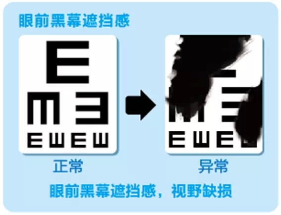 視網(wǎng)膜脫離啥癥狀？這張圖告訴你！