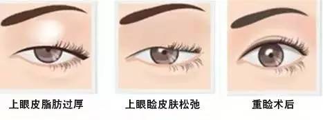 為什么要做雙眼皮？5個(gè)理由說服你！