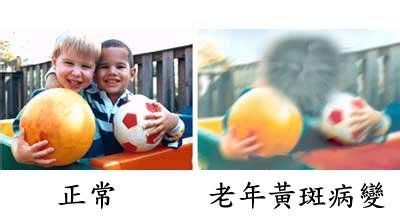 黃斑變性與老花眼，兩者不一樣！