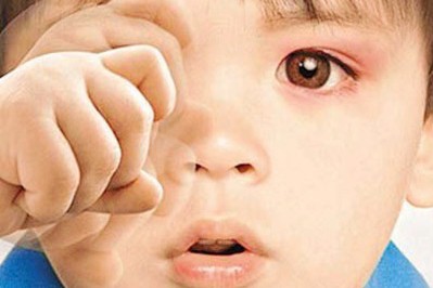 秋季紅眼病高發(fā)，當(dāng)心孩子被傳染