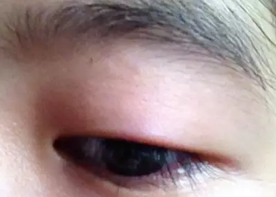 “美目貼”別依賴，小心眼皮下垂