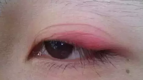 “美目貼”別依賴，小心眼皮下垂