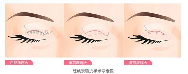 眼整形的恢復(fù)期是多長？你肯定想知道！