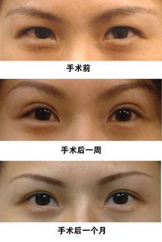 眼整形的恢復(fù)期是多長？你肯定想知道！