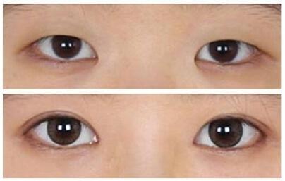 眼整形的恢復(fù)期是多長？你肯定想知道！