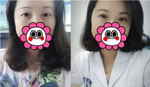 要不要做雙眼皮？別糾結(jié)了看這個！