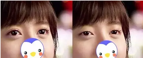 要不要做雙眼皮？別糾結(jié)了看這個！