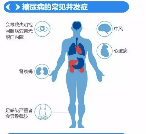 你造嗎？糖尿病晚期眼睛會(huì)致盲！