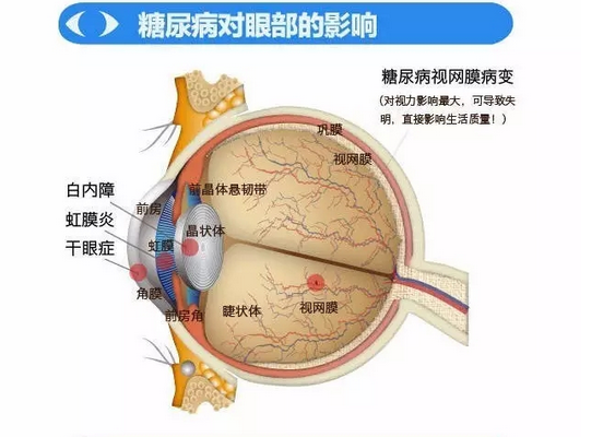 你造嗎？糖尿病晚期眼睛會(huì)致盲！