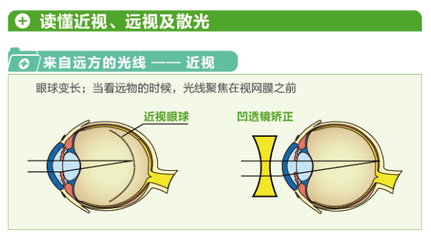 【看圖解】一張圖教你看懂近視、遠(yuǎn)視和散光