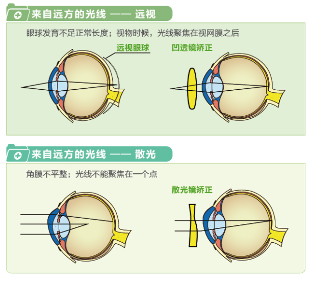 【看圖解】一張圖教你看懂近視、遠(yuǎn)視和散光