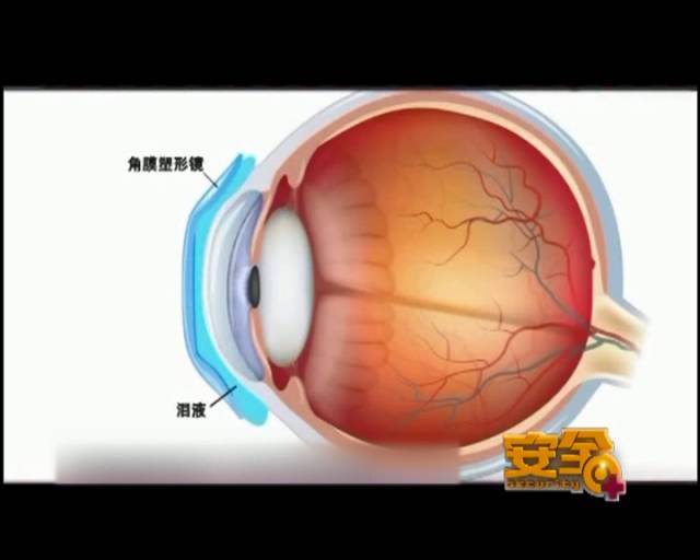 一夜之間真的能改變視力嗎？