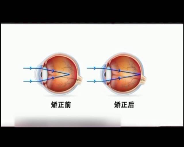 一夜之間真的能改變視力嗎？