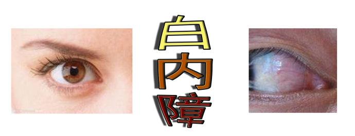 白內(nèi)障手術(shù)會反復(fù)嗎？
