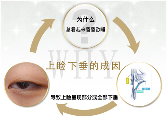拯救惺忪睡眼，告別上瞼下垂！