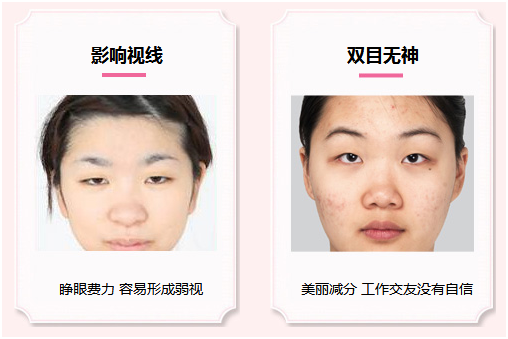 拯救惺忪睡眼，告別上瞼下垂！
