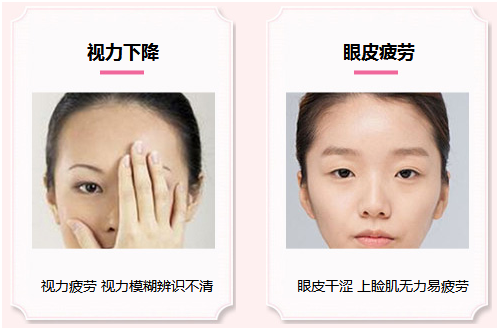 拯救惺忪睡眼，告別上瞼下垂！