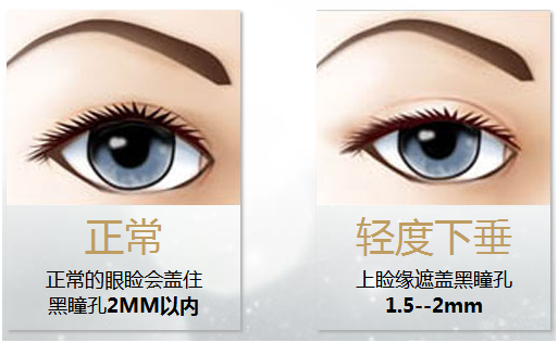 拯救惺忪睡眼，告別上瞼下垂！