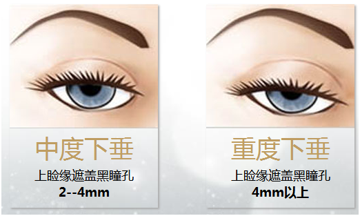 拯救惺忪睡眼，告別上瞼下垂！