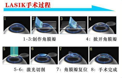 他們很有錢，但寧愿戴眼鏡都不做近視手術(shù)