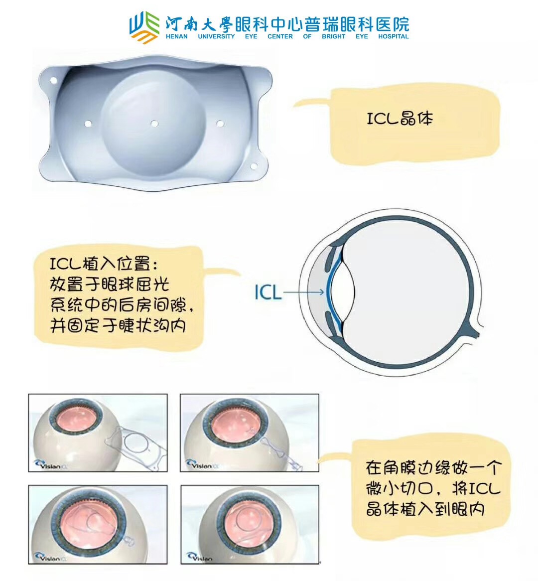 近視度數(shù)太高，還能做手術(shù)嗎？