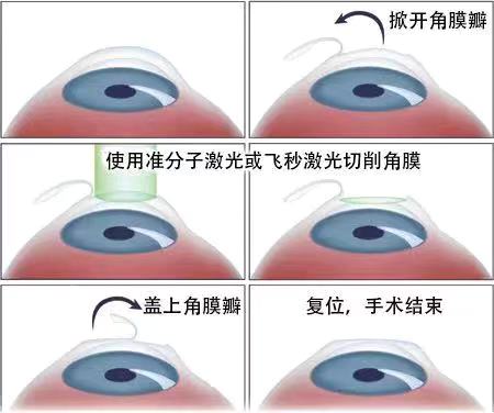 如果眼睛近視了該怎么？