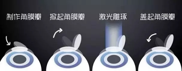 激光近視矯正和ICL晶體植入近視矯正攻略，