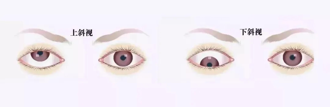 關(guān)于斜視，這幾個(gè)誤區(qū)害人不淺!