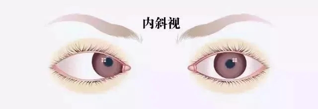 關(guān)于斜視，這幾個(gè)誤區(qū)害人不淺!