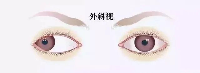 關(guān)于斜視，這幾個(gè)誤區(qū)害人不淺!