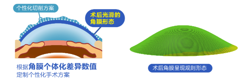 微雕優(yōu)視飛秒，重新定義角膜屈光手術(shù)，讓視力多看一行！